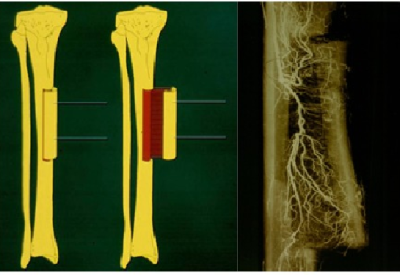 Source: Introduction to the sources and applications of external fixators for orthopedics, https://docbook.com .cn/information/409